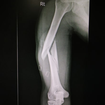 supracondylar fracture of humerus